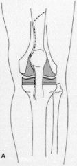 Meek et al compared the rectus snip to a standard medial parapatellar approach for revision total knee arthroplasty. The WOMAC function, pain, stiffness and satisfaction scores demonstrated no statistical difference. They concluded that use of a r...