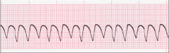 - Wide & ugly QRS
- rate: over 100