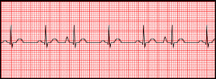 - one early beat
- p wave morphology that isn't inverted