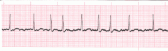 - like atrial flutter but atria quiver instead of rapid contractions