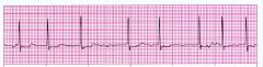- like atrial flutter but atria quiver instead of rapidly contract