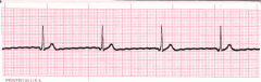 - below 60 bpm
- inverted p wave
- often have squiggly lines, slightly