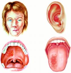 1. When there is reactivation of latent VZV residing within the geniculate ganglion with subsequent spread of the inflammatory process to involve the 8th cranial nerve.

2. Ipsilateral facial paralysis, ear pain, and vesicles in the auditory canal...