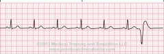 - early beat like pac
- inverted qrs
