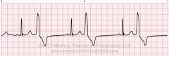 - early beat
- inverted qrs
- occurs every 2 beats