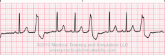 - early beat
- inverted qrs
- occurs every 3 beats