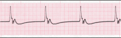 - ugly contractions
- very slow, 40 bpm