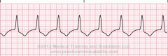 - fat ugly contractions
- between 40-100 bpm, faster than idioven. rhythm