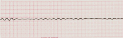 - absence of normal qrs's
- usually slowly flatlines