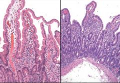 Which is normal duodenal mucosa and what is the pictured pathology?