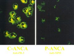 C-ANCA (anti PR-3)


 


(^Ab directed against neutrophils & monocytes)


 