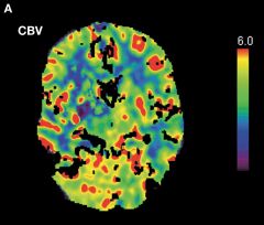 CT perfusion provides maps of relative cerebral blood volume, blood flow, mean transit time, and time to peak. Mismatch between relative cerebral blood volume and relative cerebral blood flow indicates that there may be salvageable brain tissue