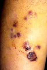  -


overlying skin changes

-CD31 is a sensitive marker for angiosarcoma