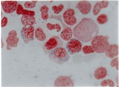 This type of anemia is associated with mitochondrial iron loading in the marrow erythroid precursors (ringed sideroblasts) and ineffective erythropoeisis. 


 


The body has adequate iron, but it is unable to incorporate it into hemoglobin....