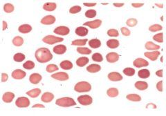 -Ringed sideroblast seen in bone marrow with a Prussian Blue stain


-Increased erythtopoietic activity in bone marrow


-Bone marrow will appear hypercellular, but the number of circulating reticulocytes is not elevated


-Mature red cells ...