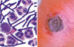 - Boil like lesion → ulcer with black eschar (painless, necrotic)
- Uncommonly progresses to bacteremia and death
