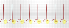 -P-top komt duidelijk na QRS (geel)
-smal QRS (tenzij bij bundeltakblok)
-PR tachycardie