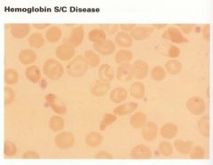 Sickle C disease