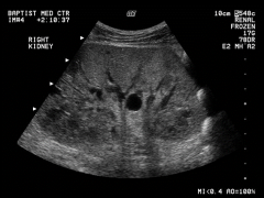 Which type of renal cyst?