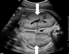 Fetus - which renal pathology?