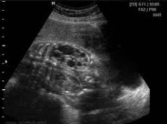 Fetus - which renal pathology?