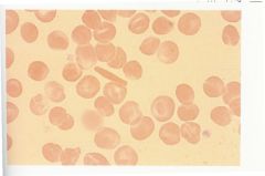 -Hb C differs from Hb A in one amino acid


-When Hb C is deoxygenated, it tends to form intracellular crystals


-Red cells are normochromic and normocytic


-More than 50% of cells are target cells


-Mild, chronic hemolytic anemia with ...