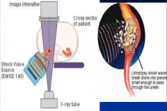 Shock wave -> negative pressure bubble - acoustic cavitation; combined with positive (compression) wave causing shear / tensile stress.
Vascular response: transient but marked reduction in renal perfusion/GFR; structural changes due to rupt...