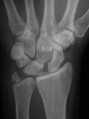 injury and x ray finding