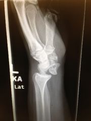 injury and xray finding?
