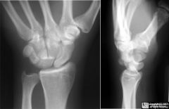 Injury and x ray findings?