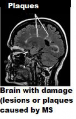 Active Lesions

MRI contrast agents (gadolinium):
-improve visibility (internal body structures)
-administered orally or intravenously
-exposed to strong magnetic field
-radiofrequency pulse
-causes the atoms in the contrast agents to spin
...