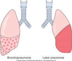 1. Bronchopneumonia: Begins as acute bronchitis and spreads locally into the lungs. Usually involves lower lobes or right middle lobe. Lung has patchy areas of consolidation (microabscesses are present in the areas of consolidation).
2. Lobar pneumonia. 