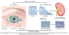 Keratomalacia of the eye. Vitamin A is needed to maintain specialized epithelia. E.g. the conjunctiva of the eye (stratified columnar). The metaplasia thickens the surface, resulting in keratomalacia.