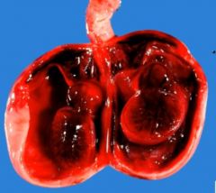 It's a type of infarction that occurs if blood re-enters a loosely organized tissue (so it can hold the blood, giving it a red color). 

The picture shows a testicle that has undergone red infarction (e.g. testicular torsion).