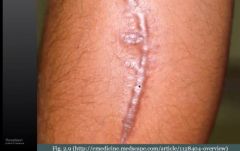 Aberrant healing process: Excess production of scar tissue that is localized to the wound (type I collagen)