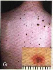 This syndrome is a risk factor for developing malignant melanoma. What is this syndrome? Give three facts.