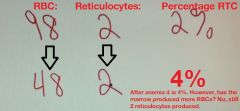 falsely elevated

A decrease in total RBCs, falsely elevates the percentage of reticulocytes.