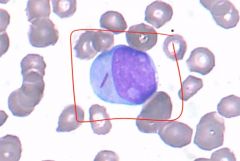 Is this a myeloblast or lymphoblast?