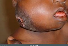 (1) African form that usually involves the jaw
(2) Sporadic form that usually involves the abdomen