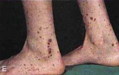 (1) Palpable purpura on buttocks and legs
(2) GI pain and bleeds
(3) Hematuria (IgA nephropathy)