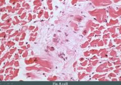 The image shows an aschoff body. It's a focus of chronic inflammation with giant cells and fibrinoid material (degenerated collagen) with a group of cells called the Anitschkow cells.