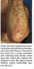 Dermatitis herpetiformis. Due to IgA deposition at tips of dermal papillae, disrupts connection between dermis and epidermis between those points. This results in a blister or vesicle that looks like the vesicles in herpes. Resolves with gluten free diet.