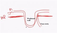 Arise where vasa recta traverse muscularis propria (weak point in colonic wall).
