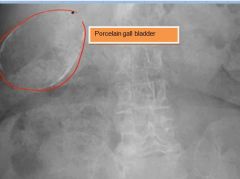 (1) Vague RUQ pain, especially after eating
(2) Porcelain gallbladder is late complication (dystrophic calcification)