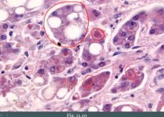 (1) Swelling or ballooning of hepatocytes with necrosis and inflammation
(2) Mallory bodies (red encircled)