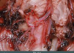 Rupture of berry aneurysm