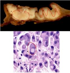 Signet ring cells that diffusely infiltrate gastric wall. This results in a reaction to the cancer called desmoplasia (fibrous tissue and blood vessels). Stomach wall thickens resulting in linitis plastica.