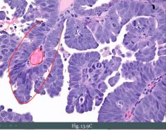 Note the papillary projection with fibrovascular core. This is the sporadic type. We could see psammoma bodies here (remember we can also see that in papillary carcinoma of the thyroid).