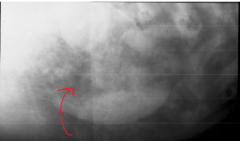 this mottled appearance in an abdomen x-ray can indicate what disease process?