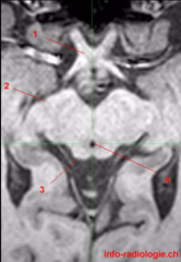 In the rostral midbrain dorsal to the cerebral aqueduct (3)
